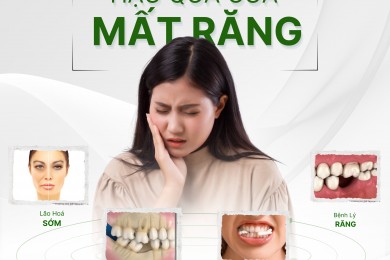 Mất Răng Vĩnh Viễn Thì Nên Làm Gì?